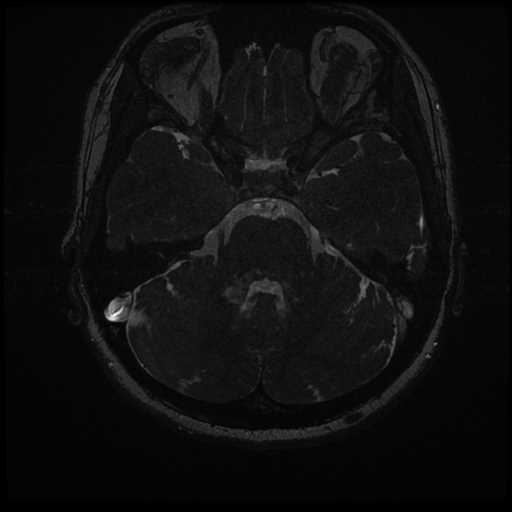Anterior inferior cerebellar artery vascular loop - type II (Radiopaedia 70991-81209 Axial 3D FIESTA 14).jpg