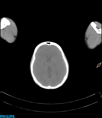 File:Anterior mediastinal seminoma (Radiopaedia 80270-93613 C 2).jpg