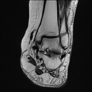 File:Anterior talofibular ligament injury - rupture with soft-tissue impingement (Radiopaedia 38765-40928 Coronal T2 16).jpg