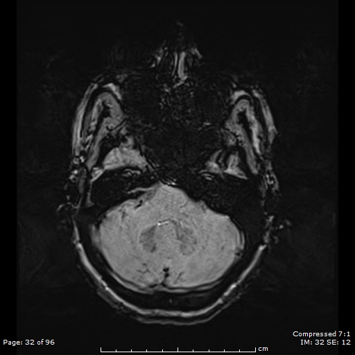 Anterior temporal lobe perivascular space (Radiopaedia 88283-104914 Axial SWI 1).jpg