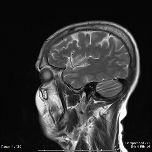 File:Anterior temporal lobe perivascular space (Radiopaedia 88283-104914 Sagittal T2 4).jpg