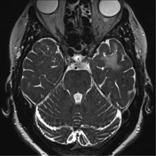 File:Anterior temporal pole cysts (Radiopaedia 46629-51102 Axial 30).png
