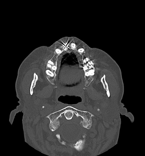 Anterior temporomandibular joint dislocation (Radiopaedia 59430-66784 Axial non-contrast 27).jpg