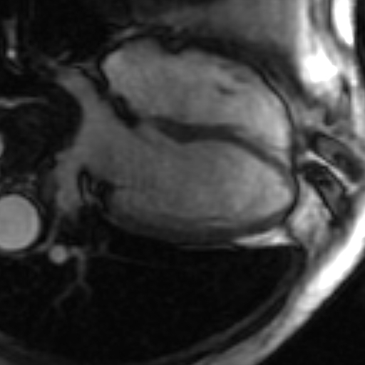 File:Anteroseptal hypokinesia after myocardial infarction (Radiopaedia 15978-15633 4 chamber view SSFE 24).jpg