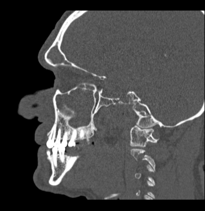 Antrochoanal polyp (Radiopaedia 79011-92169 Sagittal bone window 49).jpg