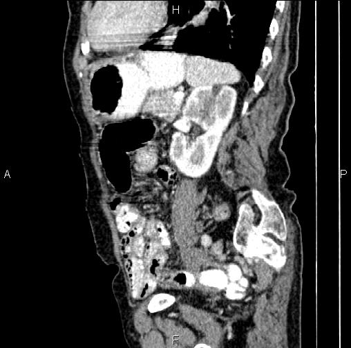 Aortic aneurysm and Lemmel syndrome (Radiopaedia 86499-102554 D 61).jpg
