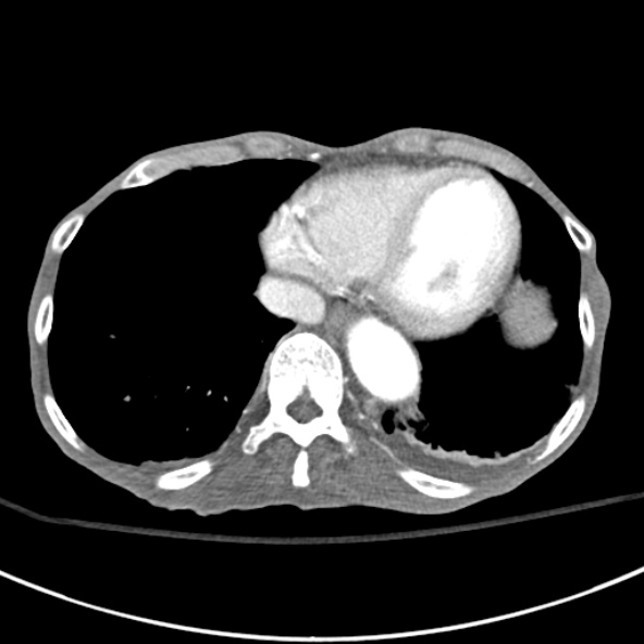 File:Aortic aneurysm with spinal destruction (Radiopaedia 42301-45410 A 4).jpg
