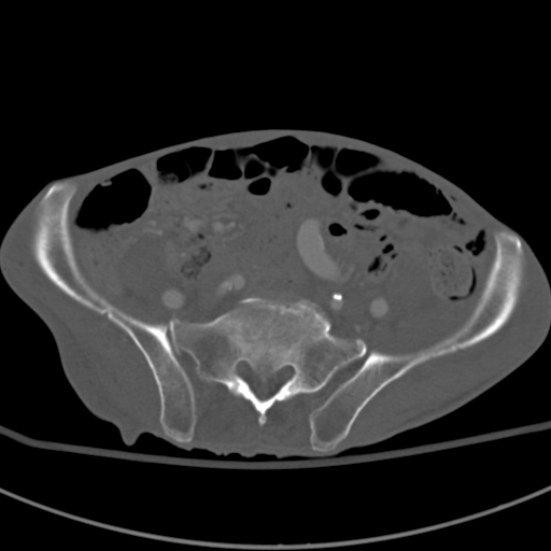 Aortic aneurysm with spinal destruction (Radiopaedia 42301-45410 Axial bone window 79).jpg