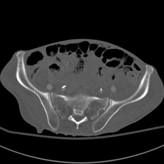 Aortic aneurysm with spinal destruction (Radiopaedia 42301-45410 Axial bone window 82).jpg