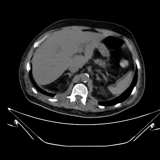 Aortic arch aneurysm (Radiopaedia 84109-99365 Axial non-contrast 278).jpg