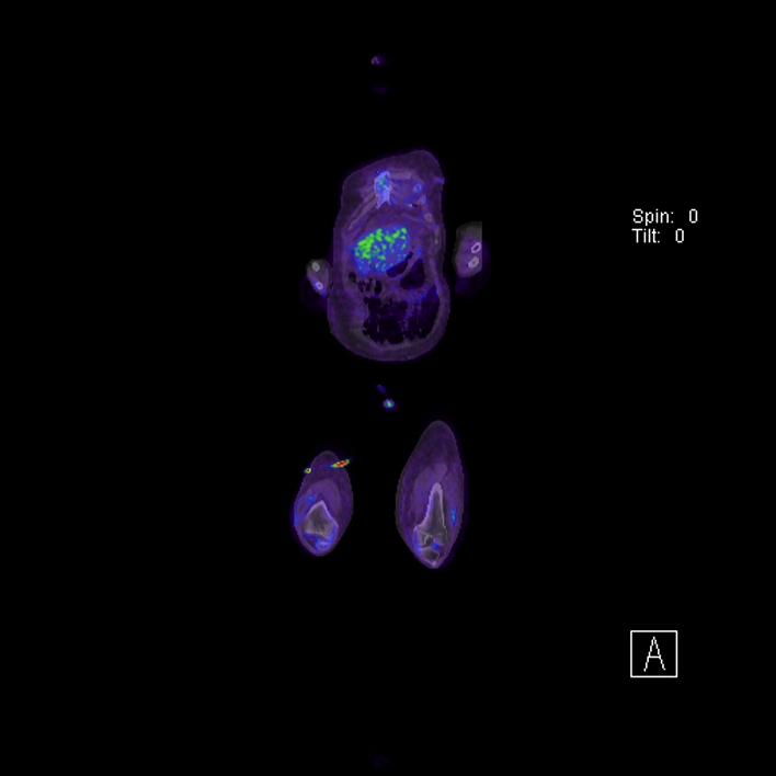 Aortic arch graft infection (FDG PET-CT) (Radiopaedia 71975-82438 B 8).jpg