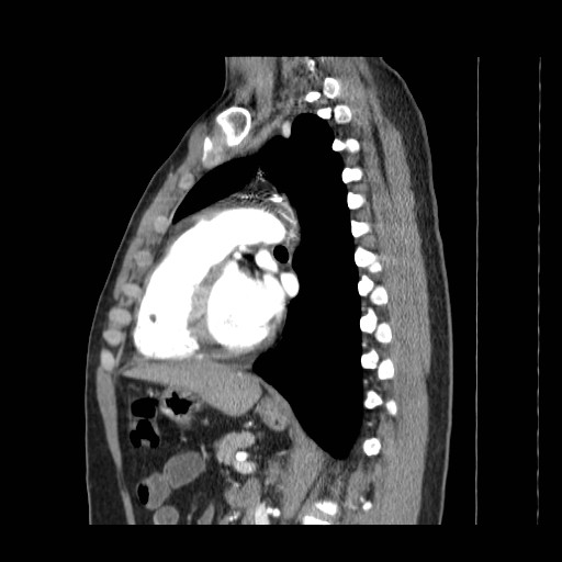 File:Aortic arch stent (Radiopaedia 30030-30595 E 16).jpg