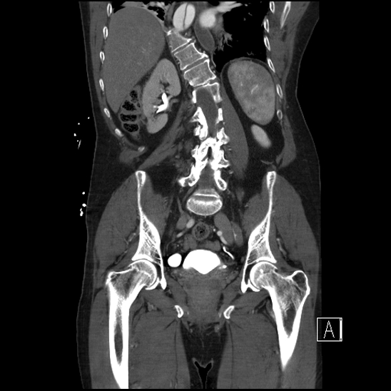 File:Aortic dissection (CTPA) (Radiopaedia 75506-86750 F 49).jpg