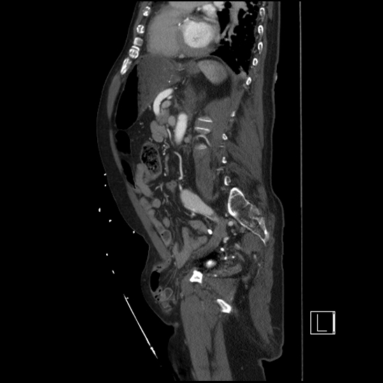Aortic dissection (CTPA) (Radiopaedia 75506-86750 G 69).jpg