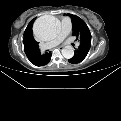 File:Aortic dissection (Radiopaedia 25350-25604 C 22).jpg