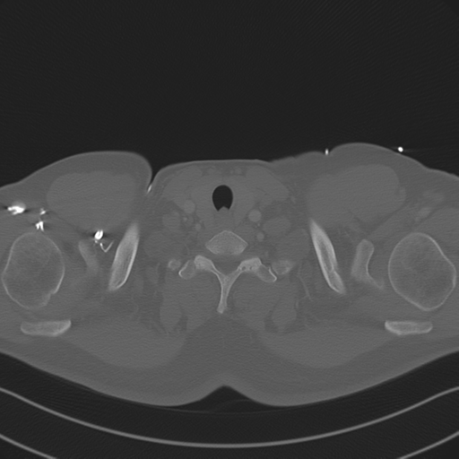 File:Aortic dissection (Radiopaedia 50763-56234 Axial bone window 8).png