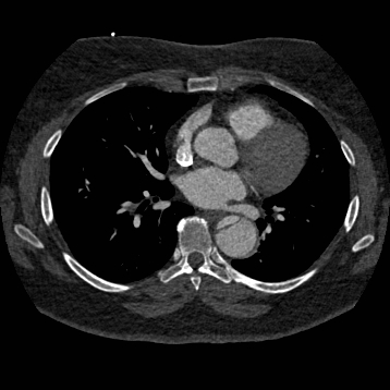 File:Aortic dissection (Radiopaedia 57969-64959 A 172).jpg