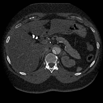 Aortic dissection (Radiopaedia 57969-64959 A 326).jpg