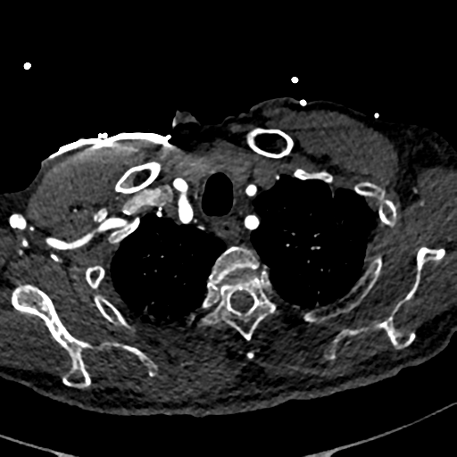 File:Aortic dissection - DeBakey type II (Radiopaedia 64302-73082 A 14).png