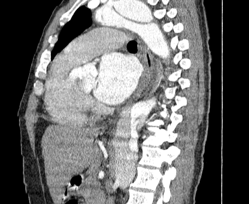 Aortic dissection - Stanford A -DeBakey I (Radiopaedia 28339-28587 C 38).jpg