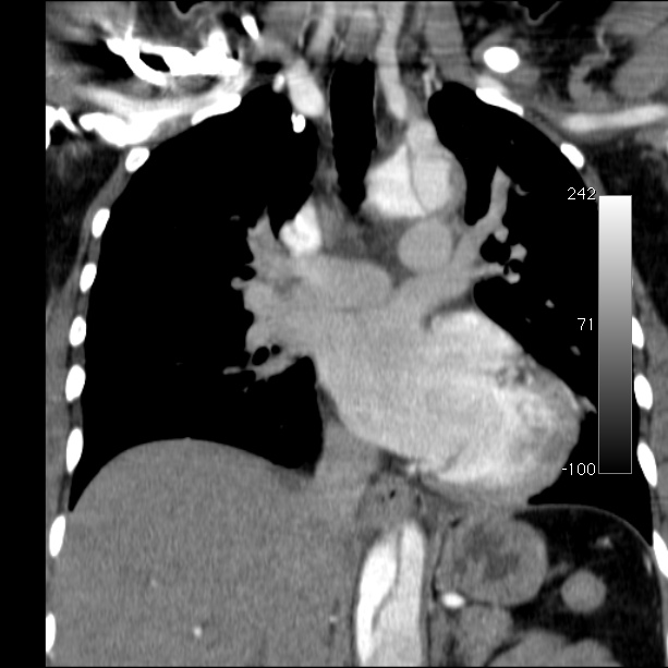 Aortic dissection - Stanford type A (Radiopaedia 29247-29659 B 32).jpg