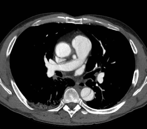 File:Aortic dissection - Stanford type B (Radiopaedia 73648-84437 A 51).jpg