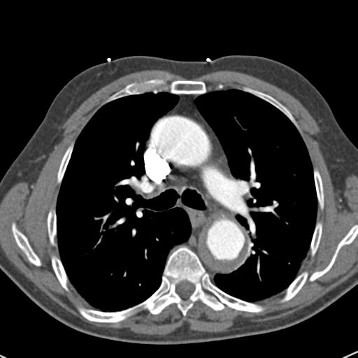 Aortic intramural hematoma (Radiopaedia 31139-31838 B 36).jpg