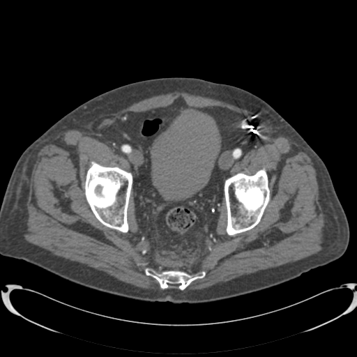 Aortic intramural hematoma (Radiopaedia 34260-35540 B 87).png