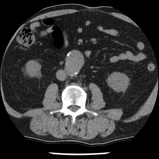 File:Aortic intramural hematoma (type B) (Radiopaedia 79323-92387 Axial non-contrast 75).jpg