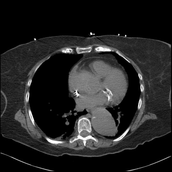 File:Aortic intramural hematoma with dissection and intramural blood pool (Radiopaedia 77373-89491 Axial non-contrast 58).jpg