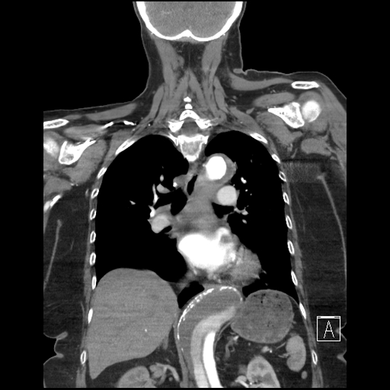 Aortic intramural hematoma with dissection and intramural blood pool (Radiopaedia 77373-89491 C 37).jpg