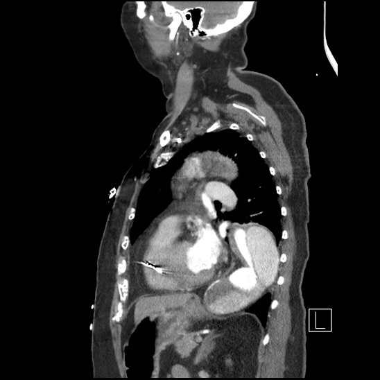 File:Aortic intramural hematoma with dissection and intramural blood pool (Radiopaedia 77373-89491 D 57).jpg