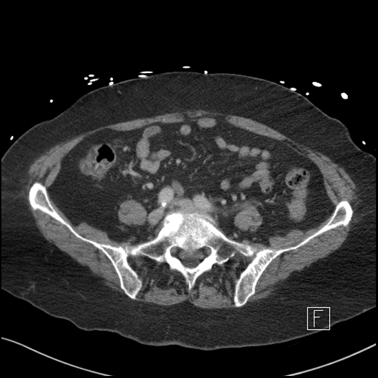 Aortic intramural hematoma with dissection and intramural blood pool (Radiopaedia 77373-89491 E 66).jpg