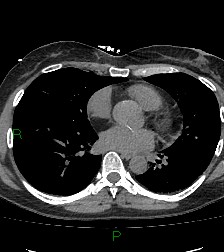 Aortic valve endocarditis (Radiopaedia 87209-103485 Axial non-contrast 60).jpg