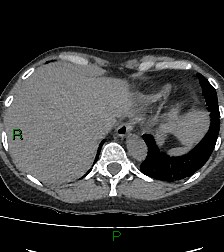 Aortic valve endocarditis (Radiopaedia 87209-103485 Axial non-contrast 84).jpg