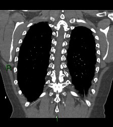File:Aortic valve endocarditis (Radiopaedia 87209-103485 D 15).jpg