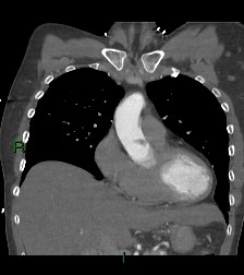 Aortic valve endocarditis (Radiopaedia 87209-103485 D 46).jpg