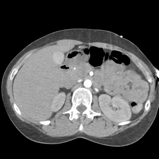 Aortic valve non-coronary cusp thrombus (Radiopaedia 55661-62189 B 56).png