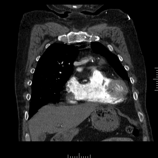 File:Aorto-coronary bypass graft aneurysms (Radiopaedia 40562-43157 B 11).png