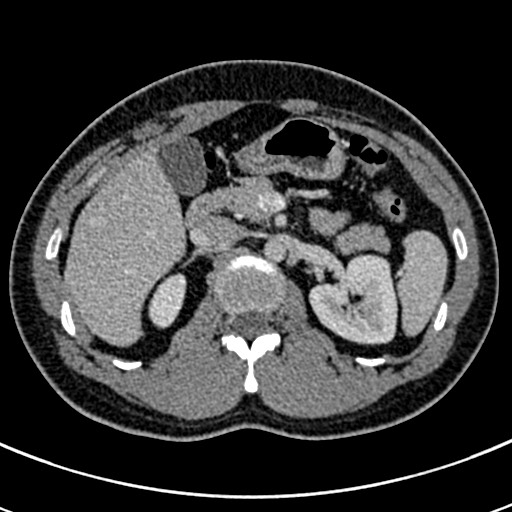 Apical lung mass mimic - neurogenic tumor (Radiopaedia 59918-67521 A 92).jpg