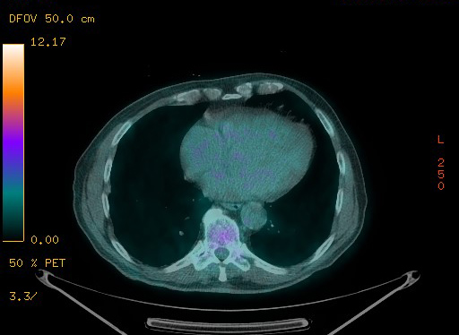 Appendiceal adenocarcinoma complicated by retroperitoneal abscess (Radiopaedia 58007-65041 Axial PET-CT 85).jpg