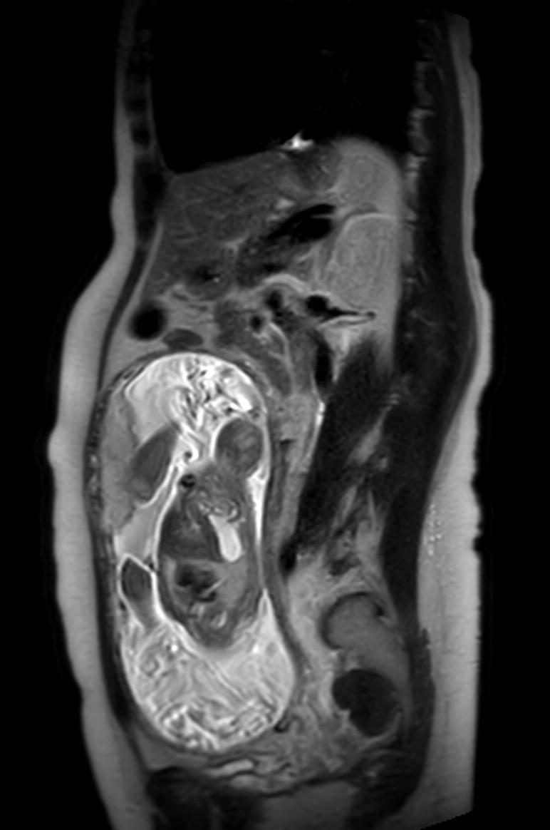 Appendicitis in gravida (MRI) (Radiopaedia 89433-106395 Sagittal T2 27).jpg