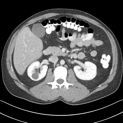 Appendicitis with cecal bar sign (Radiopaedia 31878-32830 B 32).jpg