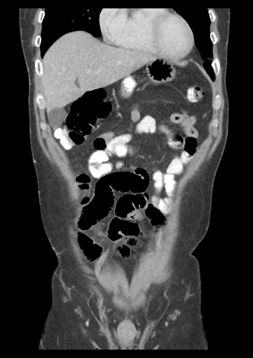 Appendicitis with thickening of the terminal ileum (Radiopaedia 42432-45550 B 15).png
