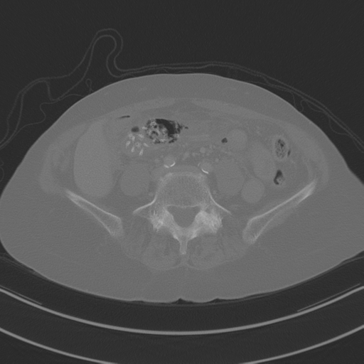 April fools' 2019- calcified peritoneal arachnoidosis (Radiopaedia 67273-76636 Axial bone window 29).png