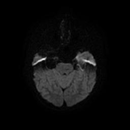Arachnoid cyst - middle cranial fossa (Radiopaedia 67671-77088 Axial DWI 9).jpg