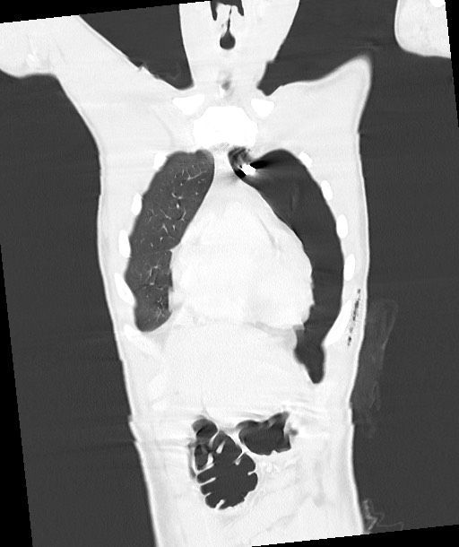 Arrow injury to the chest (Radiopaedia 85367-100975 Coronal lung window 48).jpg