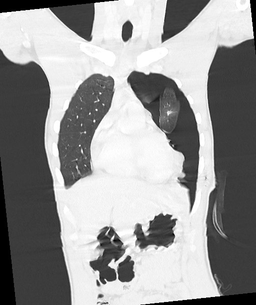 Arrow injury to the chest (Radiopaedia 85367-100975 Coronal lung window 55).jpg