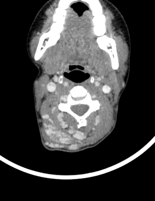 Arteriovenous malformation of the neck (Radiopaedia 53935-60062 B 19).jpg