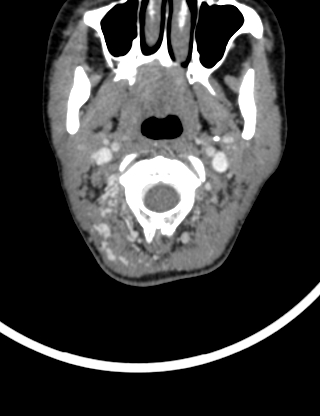 Arteriovenous malformation of the neck (Radiopaedia 53935-60062 B 9).jpg